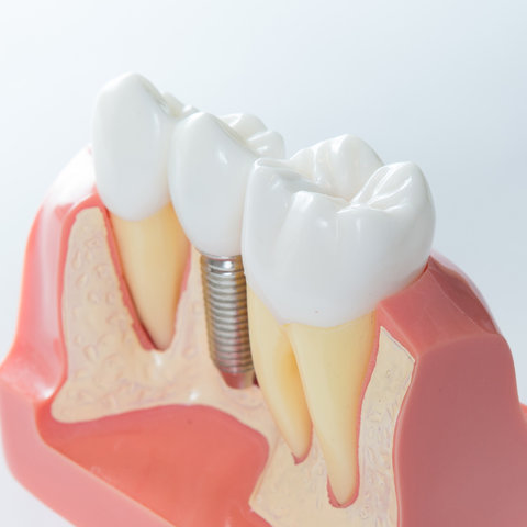 Step-by-step dental implant procedure diagram