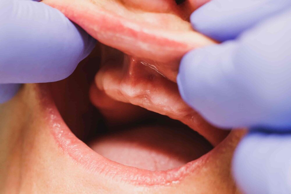 Dentist examining the upper oral tissue and palate of a patient during a dental checkup