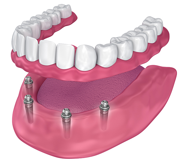 3D model of All-on-4 dental implants supporting a full arch of teeth