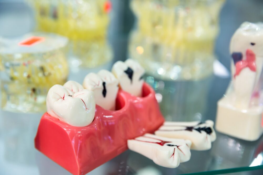 Cross-section model of a tooth showing internal structure and dental decay.
